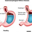 Gastroesophageal Reflux Disease