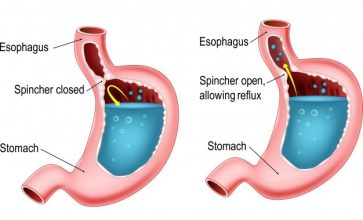 Gastroesophageal Reflux Disease