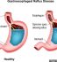 Gastroesophageal Reflux Disease