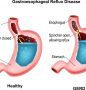 Gastroesophageal Reflux Disease