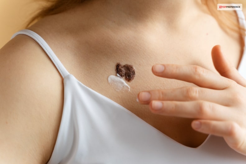 The Top Skin Tag Remover Creams To Try