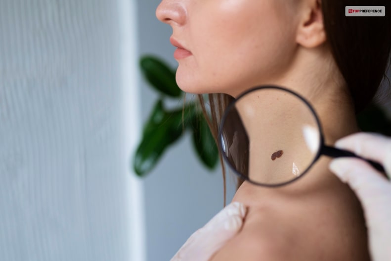 What Are The Causes Of Skin Tags?