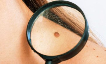 how to remove skin tags in one night