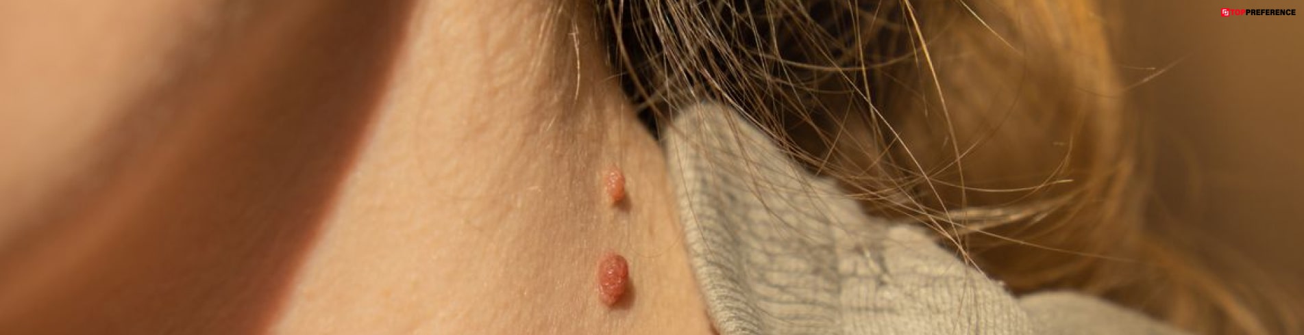 skin tags removal